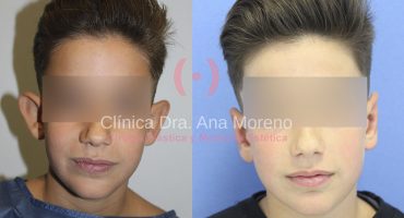 Operación de orejas en niños Granada