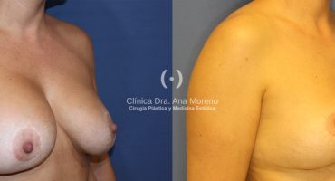 Retirada implantes mamarios
