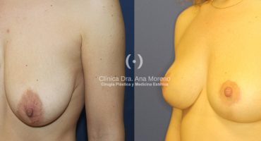Elevación mamas sin prótesis