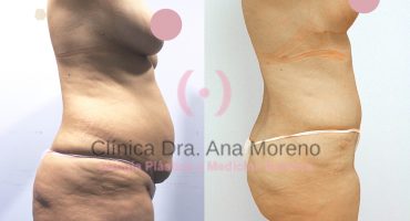 Abdominoplastia antes y después