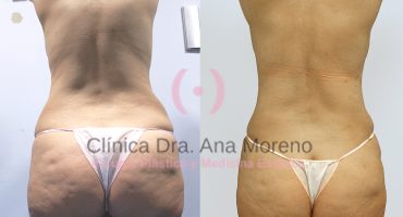 Abdominoplastia antes y después
