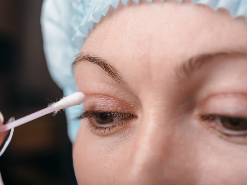 Cuidados básicos para una recuperación de blefaroplastia óptima