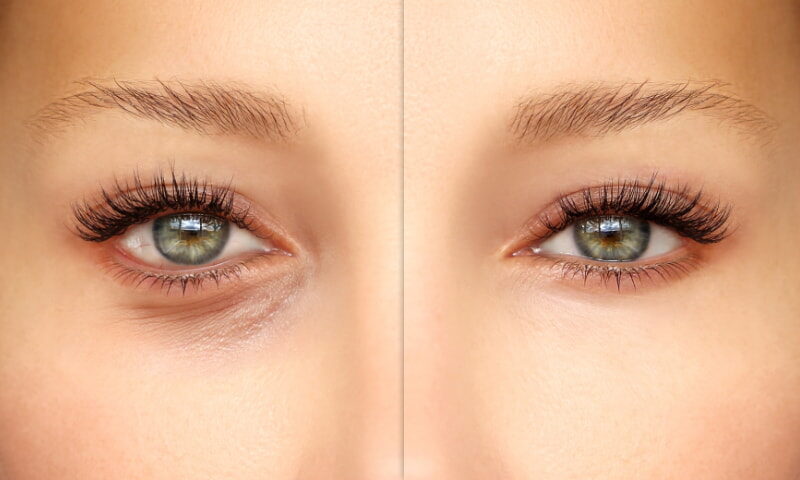 Recuperación tras una blefaroplastia etapas y consejos