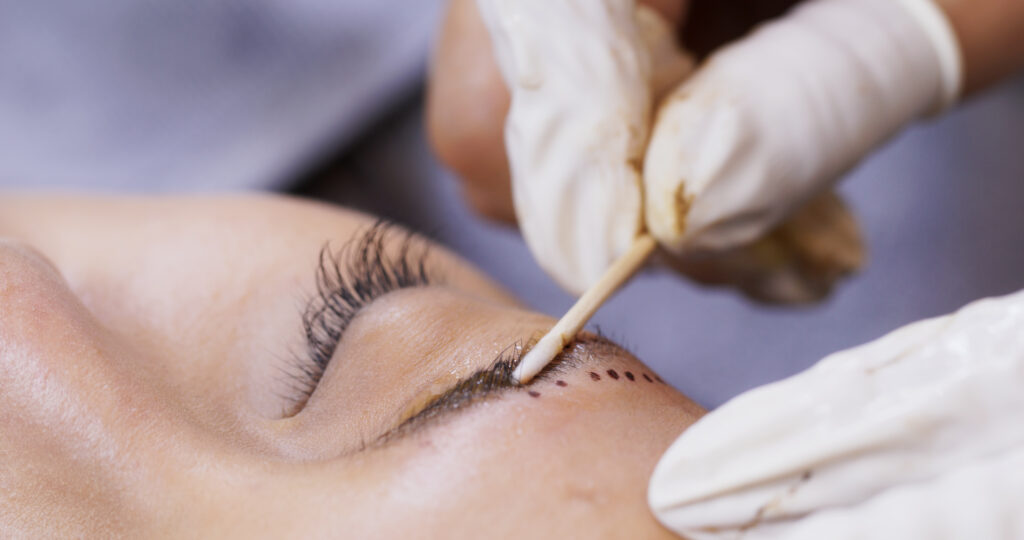 Blefaroplastia la solución para rejuvenecer tu mirada